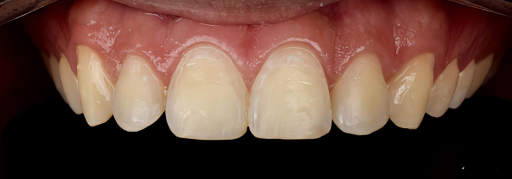 Carillas en Cerómero 1