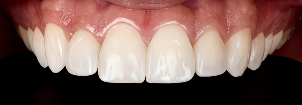 Carillas en Cerómero2