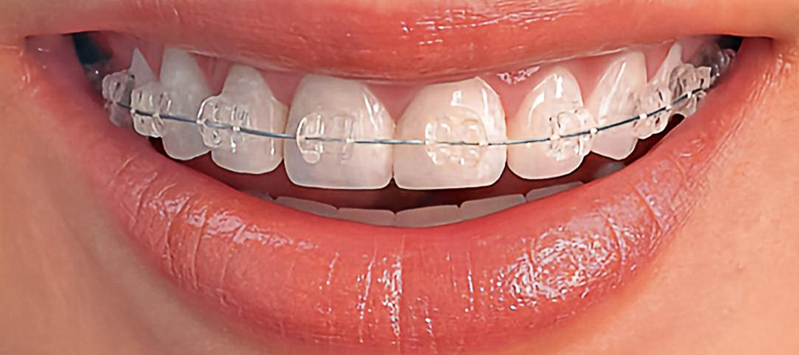 brackets zafiro