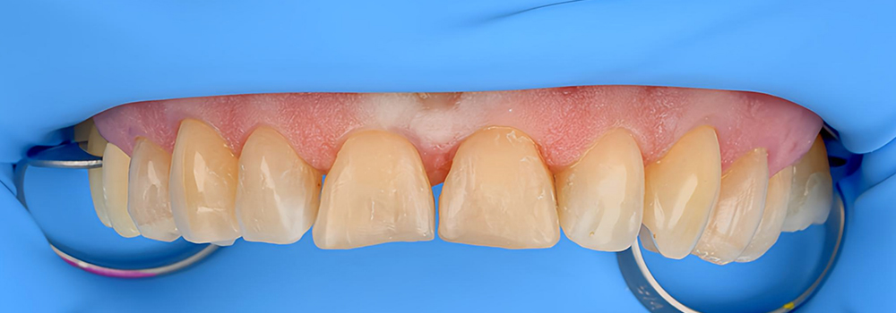 carillas de porcelana antes