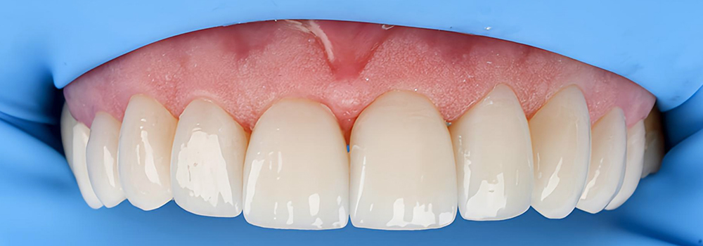 carillas de porcelana despues