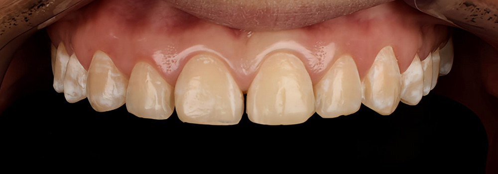 carillas de porcelana2 antes