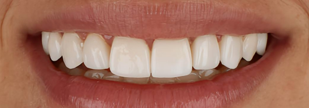 carillas de porcelana2 despues