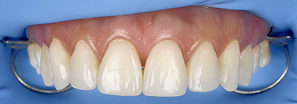 diseño de bordes despues