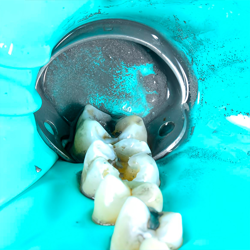 Absolute Isolation Technique and its Importance - Dr. Alejandro Martinez